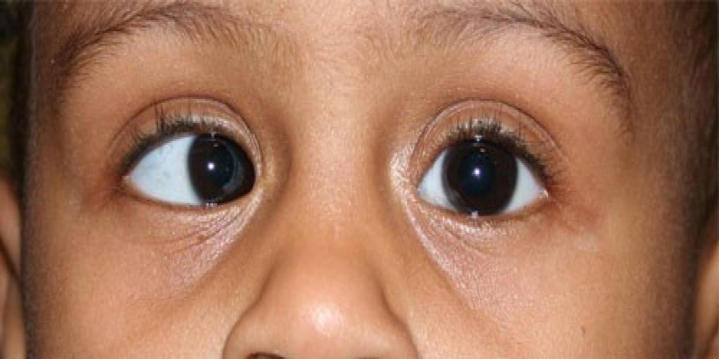 Squint or Strabismus: Can Cross-eye and other misaligned eye condition be corrected?