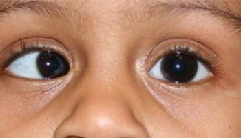 Squint or Strabismus: Can Cross-eye and other misaligned eye condition be corrected?