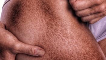 Stretch marks, also known as striae, are caused by rapid... 